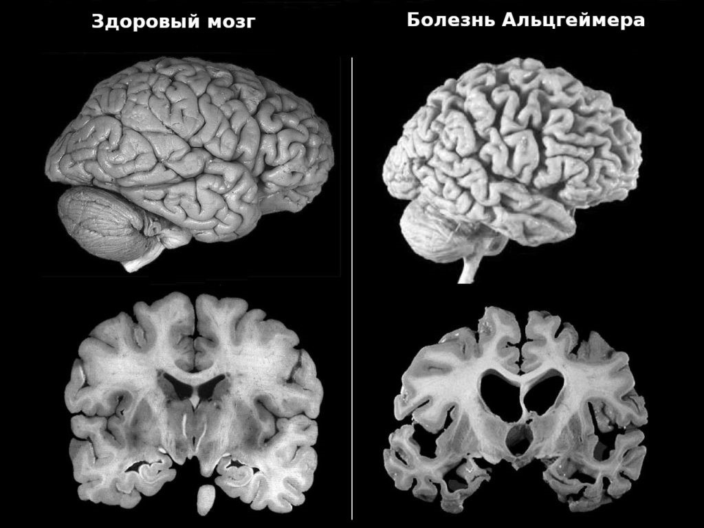 Болезнь Альцгеймера: причины, симптомы, лечение