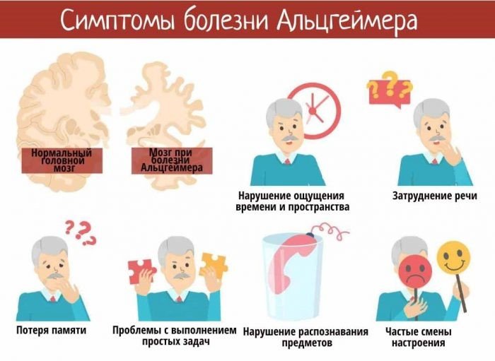 Болезнь айцгельмера это что. Альцгеймера болезнь стадии развития заболевания. Болезнь Альцгеймера симптомы. Основные симптомы болезни Альцгеймера. Этапы болезни Альцгеймера.