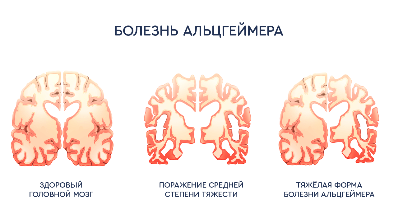 Формы Альцгеймера